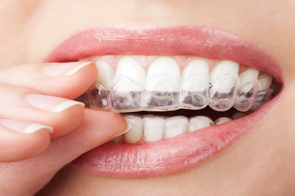 How Do Clear Aligners Move Teeth?