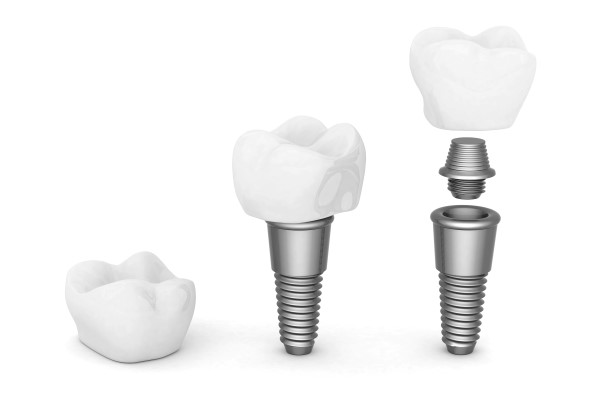 How Long Is A Dental Implant Restoration?