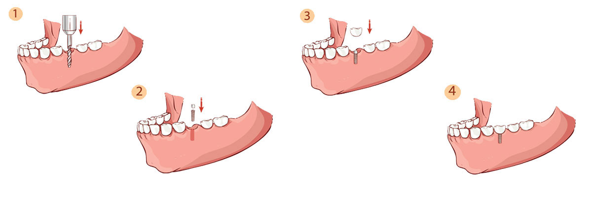 St George Dental Implant Restoration