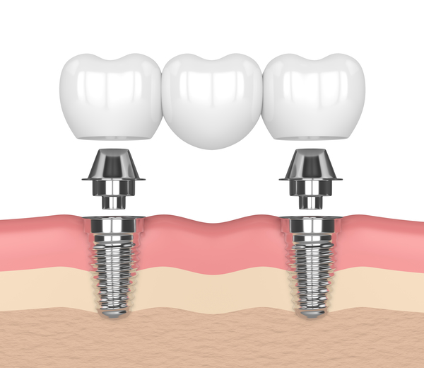 What Are Dental Implants And Do I Need Them?
