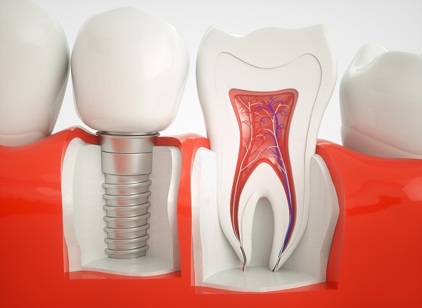 implant dentist St George, UT