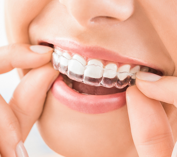 Does Invisalign Really Work?
