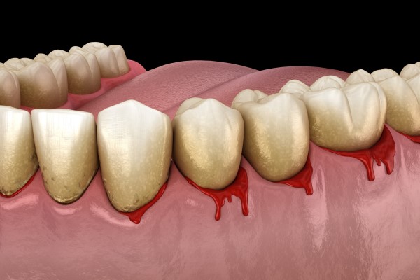 Gum Disease: Bleeding Gums Is Common