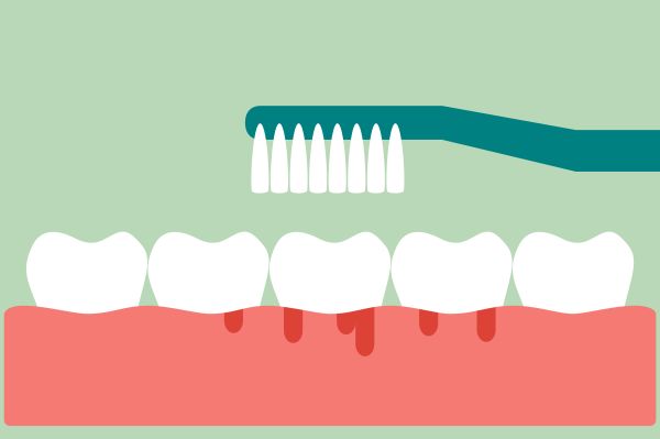 Gum Disease Periodontics