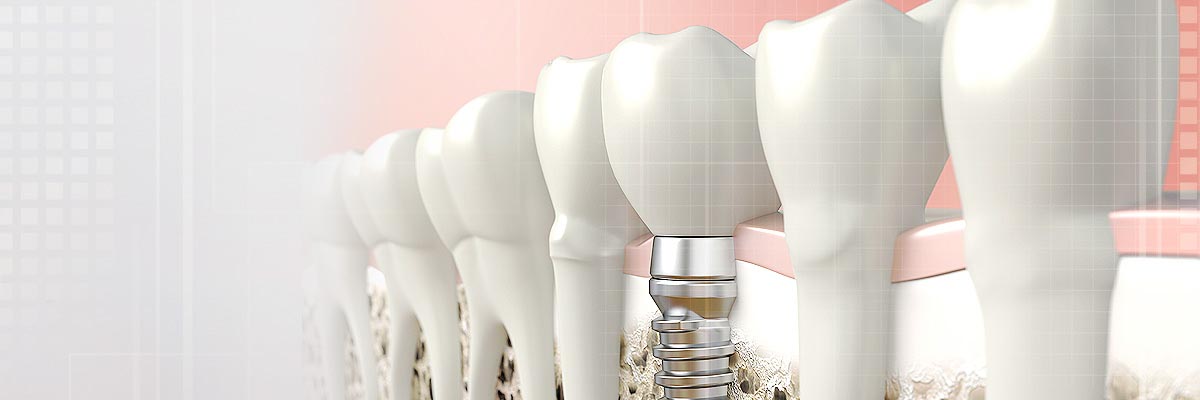 St George Implant Dentist