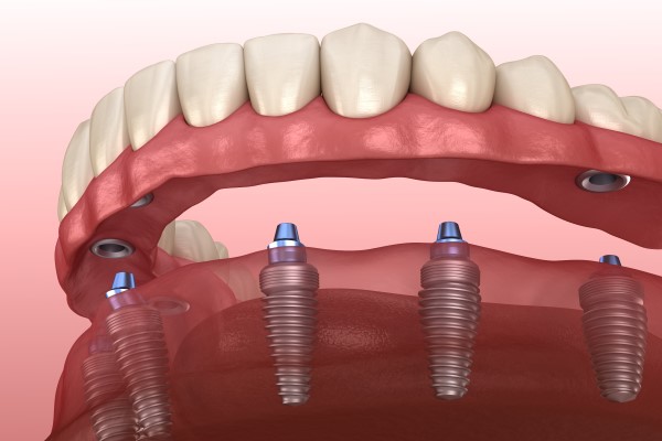Implant Supported Dentures St George, UT