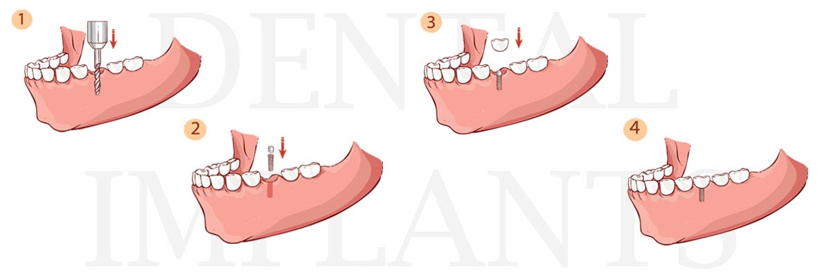 St George The Difference Between Dental Implants and Mini Dental Implants