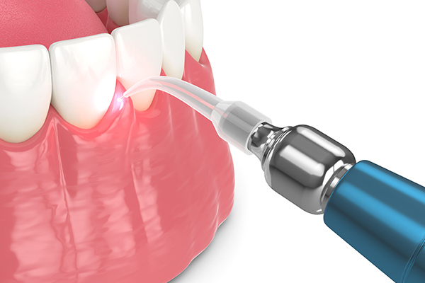 What Is Pain Free Laser Dentistry?