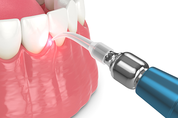Laser Dentistry St George, UT