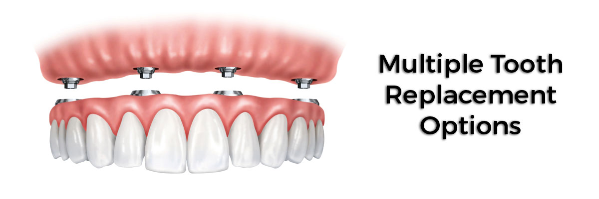 St George Multiple Teeth Replacement Options