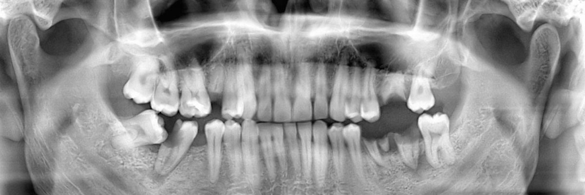 St George Options for Replacing Missing Teeth