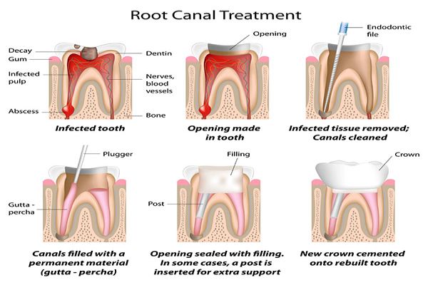 A Root Canal Dentist Can Treat Your Infected Tooth Nerves