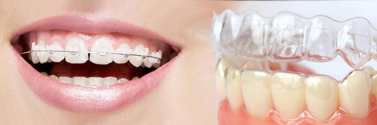 St George Which is Better Invisalign or Braces